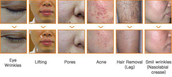 low price laser IPL skin rejuvenation machine /IPL hair removal machine